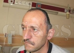 Yapay kafatası ile hayata döndü Yapay kafatası ile hayata döndü